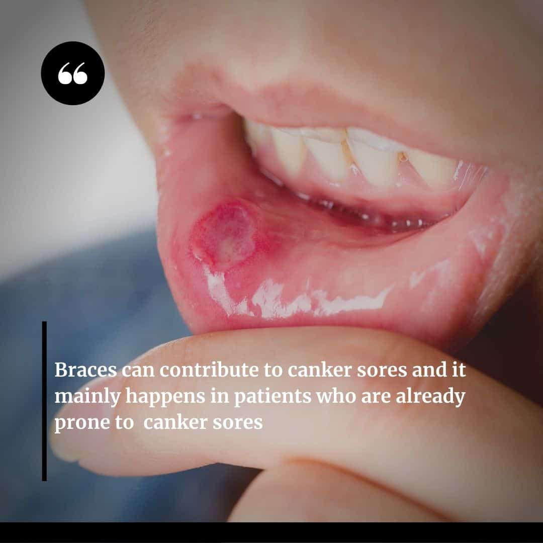 Canker Sores can happen due to braces
